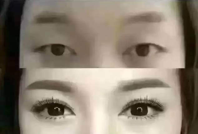 双眼皮手术，从期待到蜕变的美丽旅程
