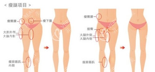 腿部吸脂手术，价格、效果与考量