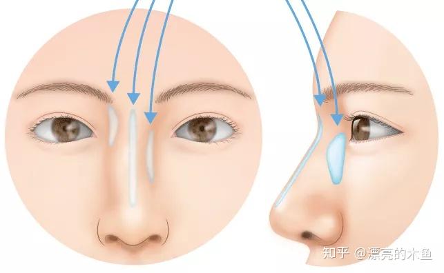 歪鼻整形手术，重塑自信的美丽之旅