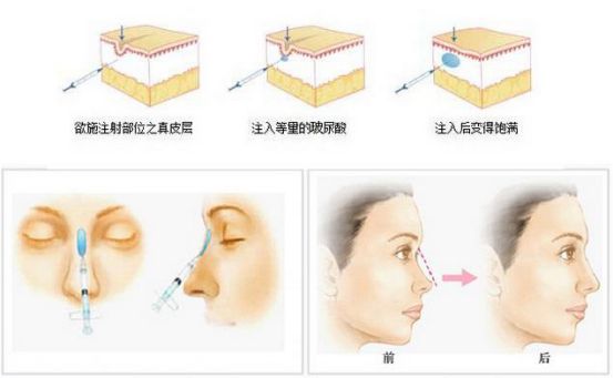 精致鼻型重塑